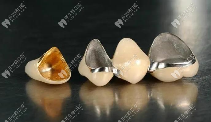 不同材质牙冠示意图
