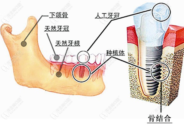 种植牙的三部分