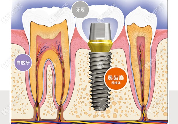 奥齿泰种植牙的图
