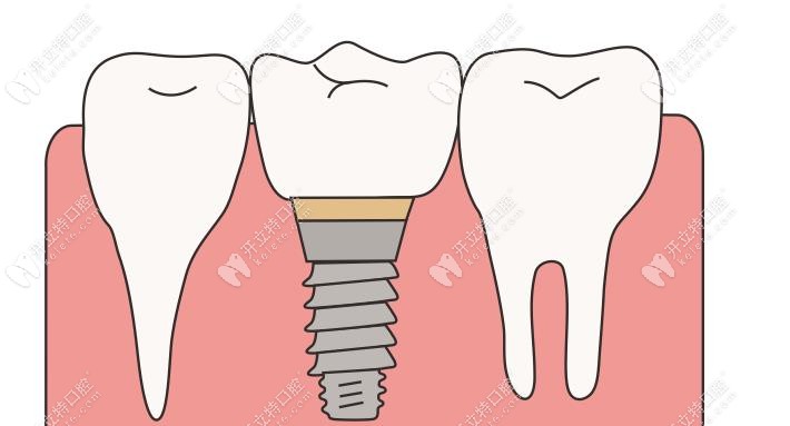 种植牙与真牙示意图www.kelete.com