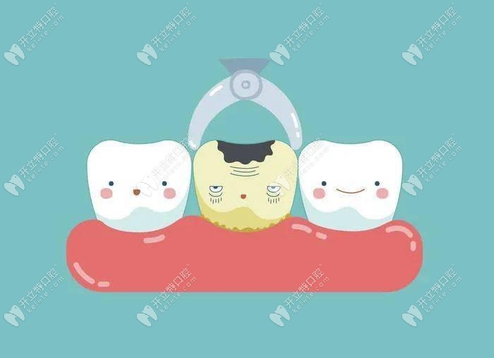 牙齿坏了怎么处理比较好的三种方法