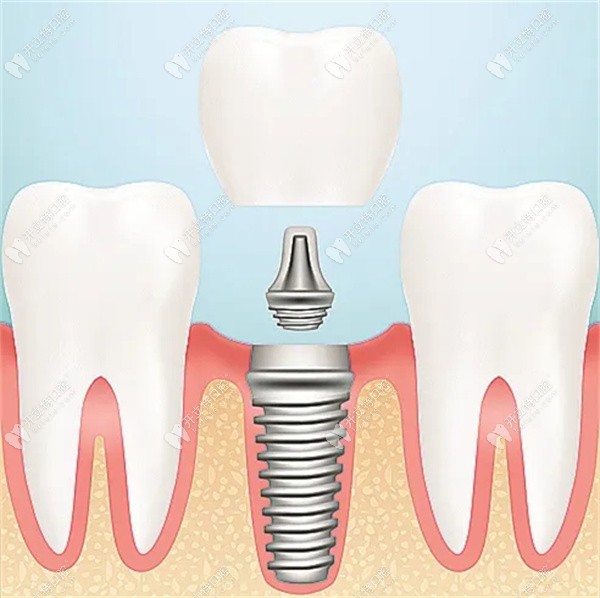 牙齿种植需要几次手术