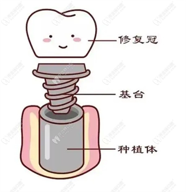 牙齿种植需要几次手术