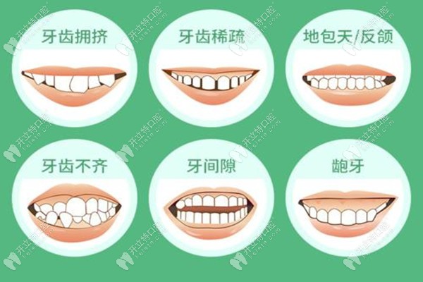 需要矫正牙齿的畸形牙类型kelete.com