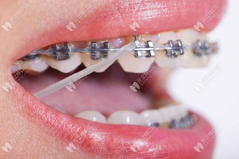 南宁青秀区牙齿矫正一般多少钱?同步口腔和柏乐口腔哪个贵