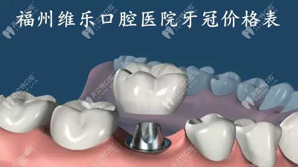 福州维乐口腔医院牙冠价格表:有钴铬合金烤瓷牙/全瓷冠费用