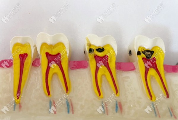 牙齿白天不疼晚上疼多是牙髓炎引起的