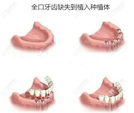 上半口假牙容易掉的原因www.kelete.com