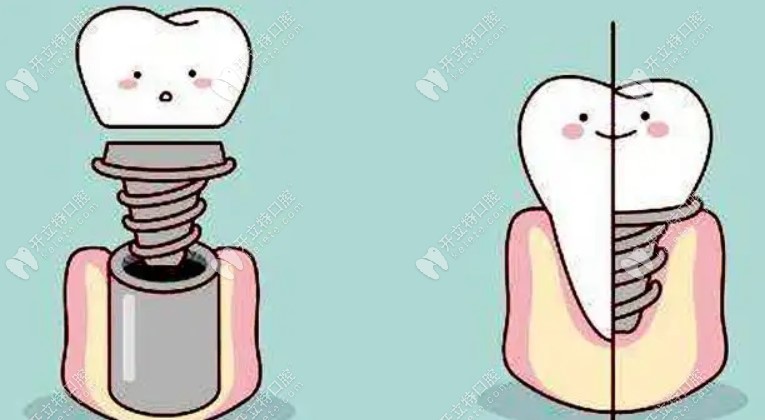 乌鲁木齐天牙口腔价格表：含天牙种植牙/全瓷牙/补牙多少钱