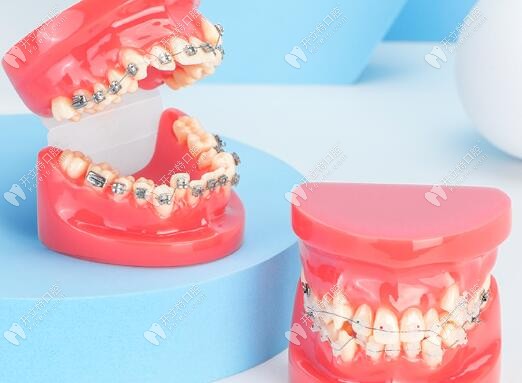 拉萨好牙医合悦丽口腔做牙齿矫正价格是8000-4万元起