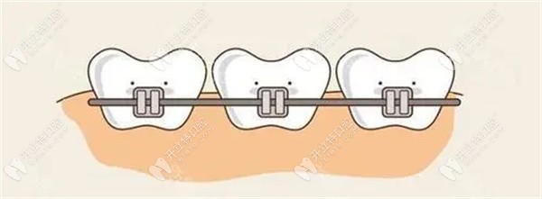 拔4颗牙齿矫正会对身体有影响吗