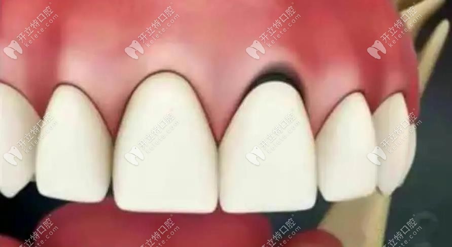 烤瓷牙冠可能出现牙龈黑线