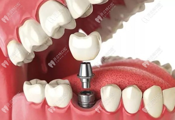 种植牙的过程图www.kelete.com
