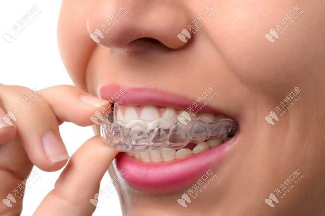 戴隐适美牙齿松动是正常吗？是不正常的