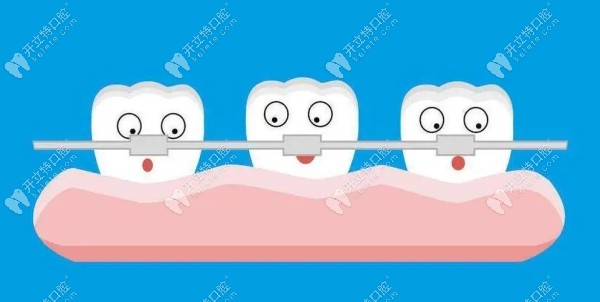 正畸时牙齿松动几度算正常?矫正期间牙齿松动1度以内属正常
