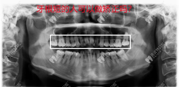 牙根短的人可以做矯正kelete.com