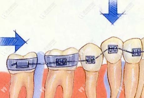 牙根短的人怎么矫正牙齿