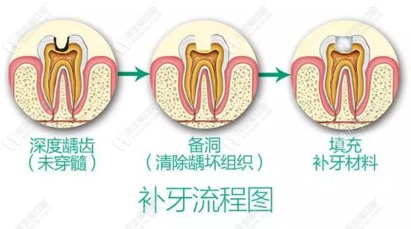 显微镜下补牙好在哪?从显微补牙和普通补牙的区别一看便知
