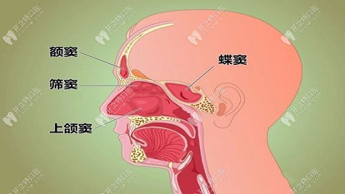 牙源性上颌窦炎结构示意图