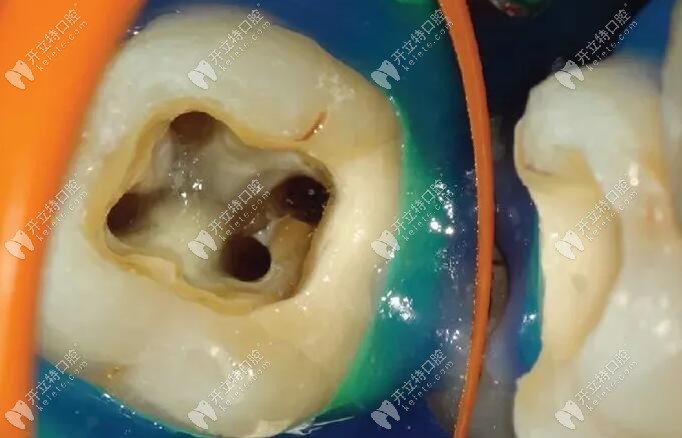 普通补牙和显微补牙对牙体组织的损伤不同