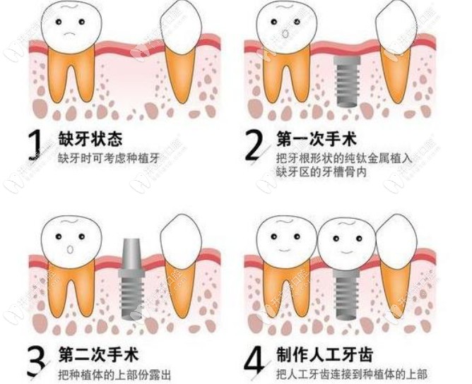 种植牙一期二期三期流程