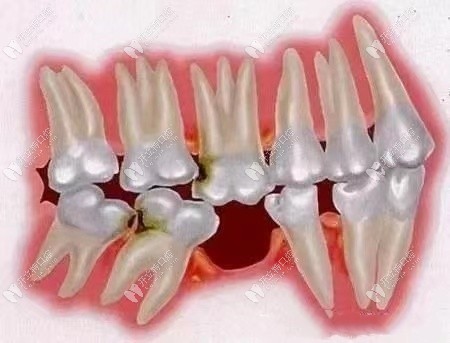 下门牙缺失一颗必须修复吗?是,可选种植牙/烤瓷牙冠来修复
