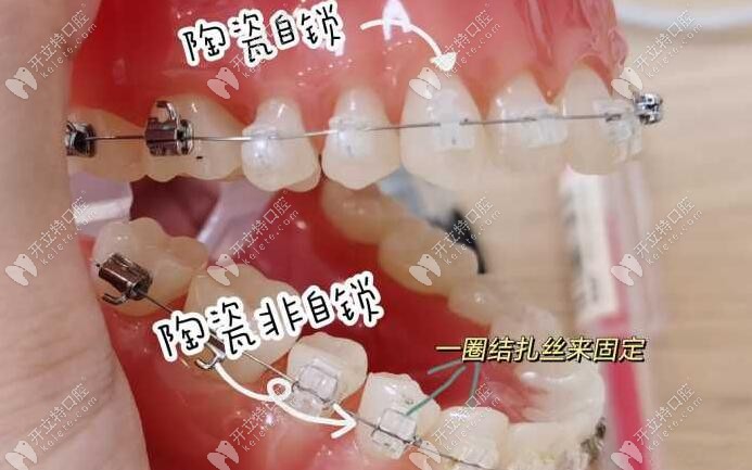 牙齿矫正半隐形是什么意思?简单讲半隐形金属托槽是透明的