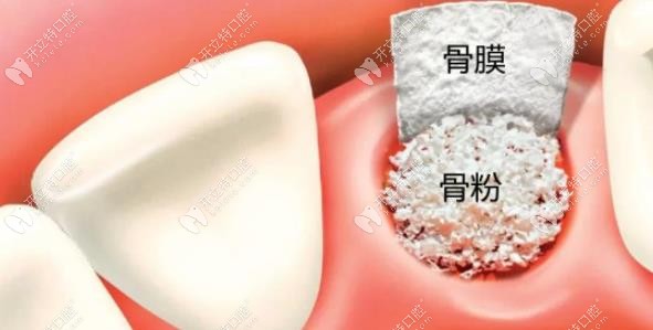 种牙填骨粉需要多少钱？国产、进口品牌的骨粉价格有区别