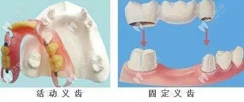 老年人镶牙可选择活动假牙，固定义齿