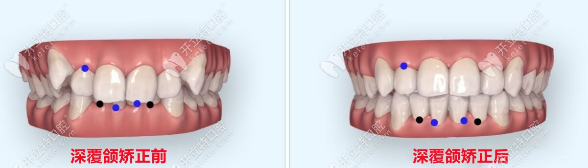 闭锁性深覆合是牙性还是骨性?不好说,闭锁性一般是骨性偏多