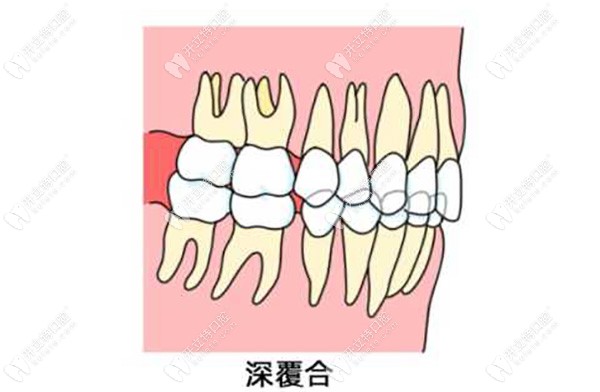 闭锁型深覆合是骨性还是牙性