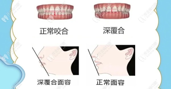 牙齿深覆合的特征有哪些?