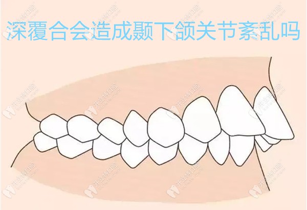 牙齿深覆合会造成颞下颌关节紊乱吗,会,不过可通过正畸改善