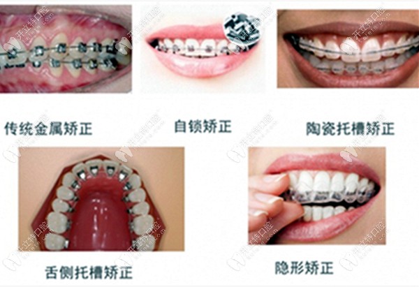 牙齿矫正器的类型www.kelete.com