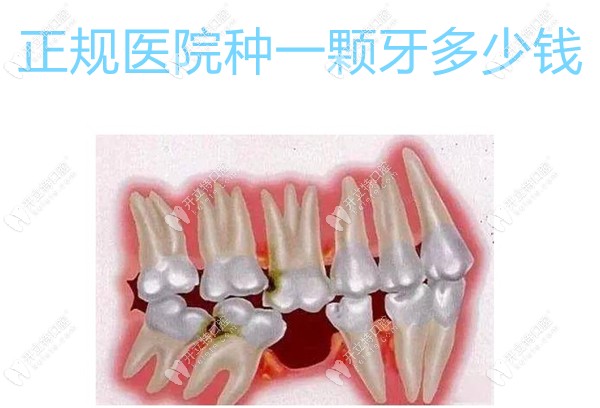 正规医院种一颗牙要多少钱,2023种植牙集采后一颗植体548元起