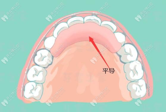 牙齿正畸戴平导的作用原理是什么?主要抬高后牙、打开咬合
