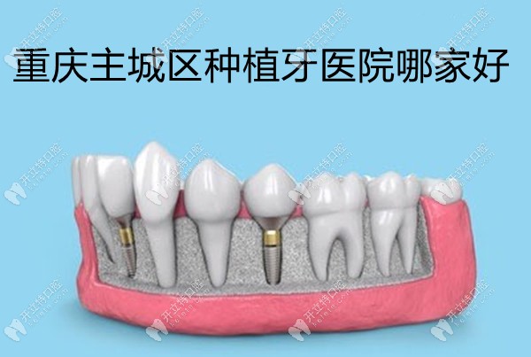 重庆主城区种植牙医院哪家好