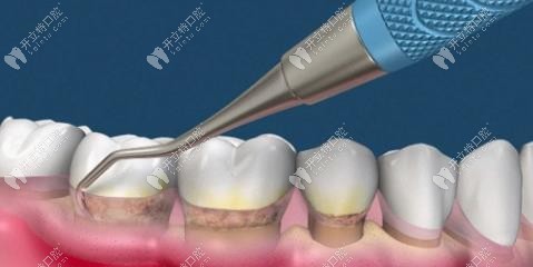 因牙结石导致龈下刮治