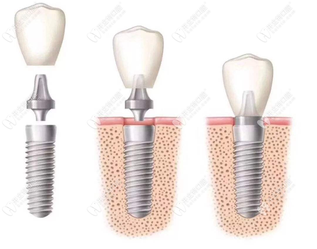 种植牙www.kelete.com