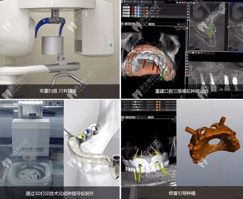 高邮贝恩口腔数字化3D导板种植技术