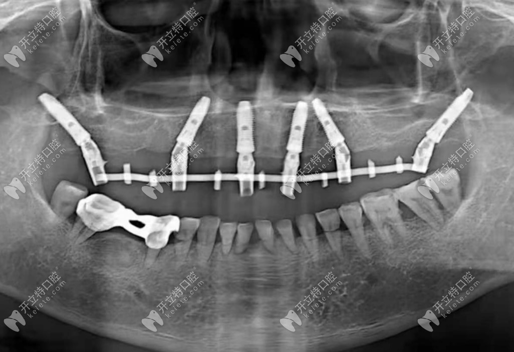 半口6颗种植牙术后CT 照
