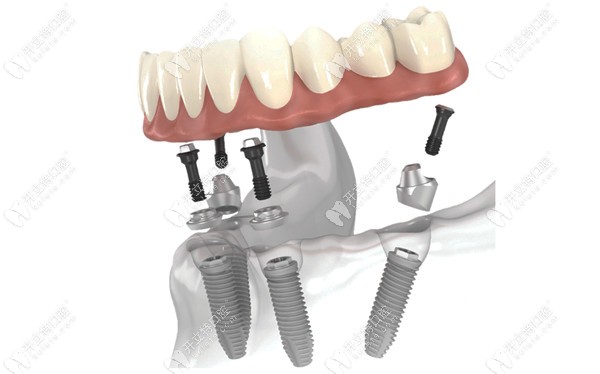 全口即刻负重种植牙的原理