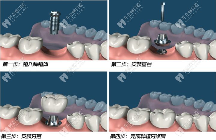 延期种植牙需要一期二期三期手术