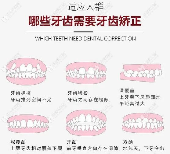 深圳福田区牙齿矫正价格一览表