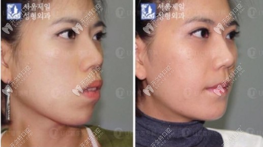 韩国UC首尔牙科医院凸嘴手术前后对比