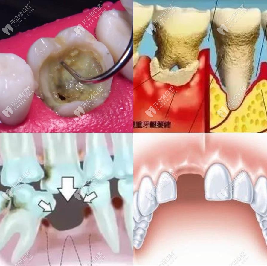 牙槽骨吸收的原因有哪些