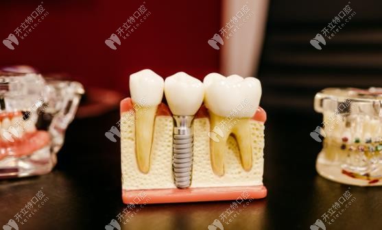 忻州恒伦口腔种植牙价格表显示:种牙5890元+,种牙不贵技术好