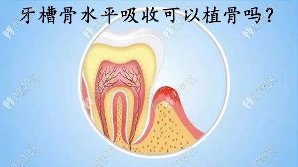 牙槽骨水平吸收可以植骨吗