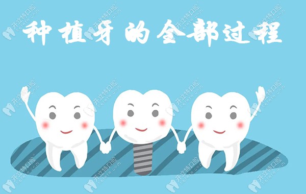 种植牙的全部过程:解答种植牙过程中要一直缺牙吗的疑问