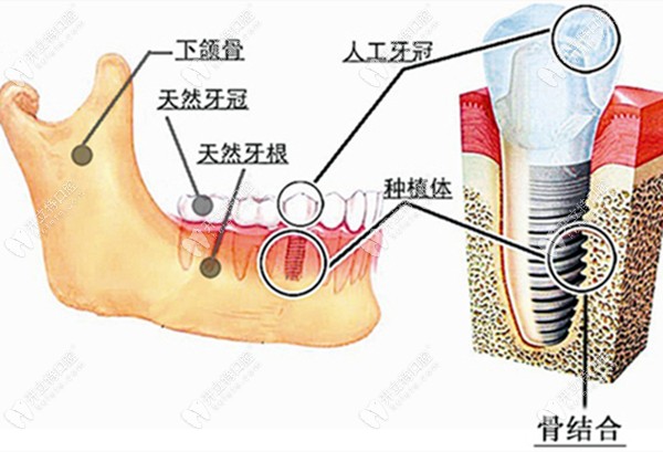 种植牙在牙槽骨内的图www.kelete.com